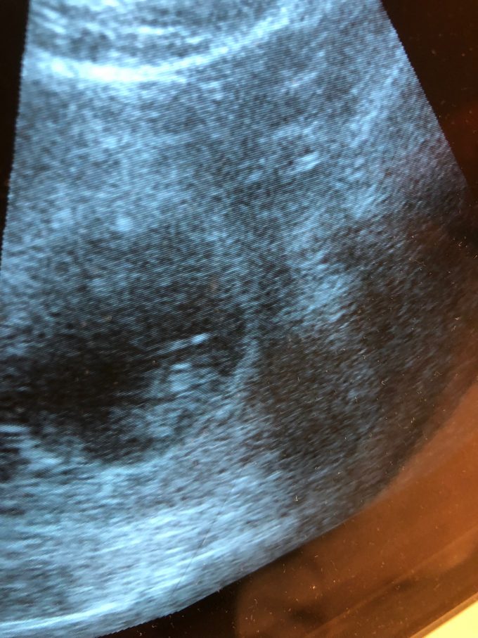First Ultrasound