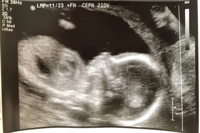 20 week ultrasound